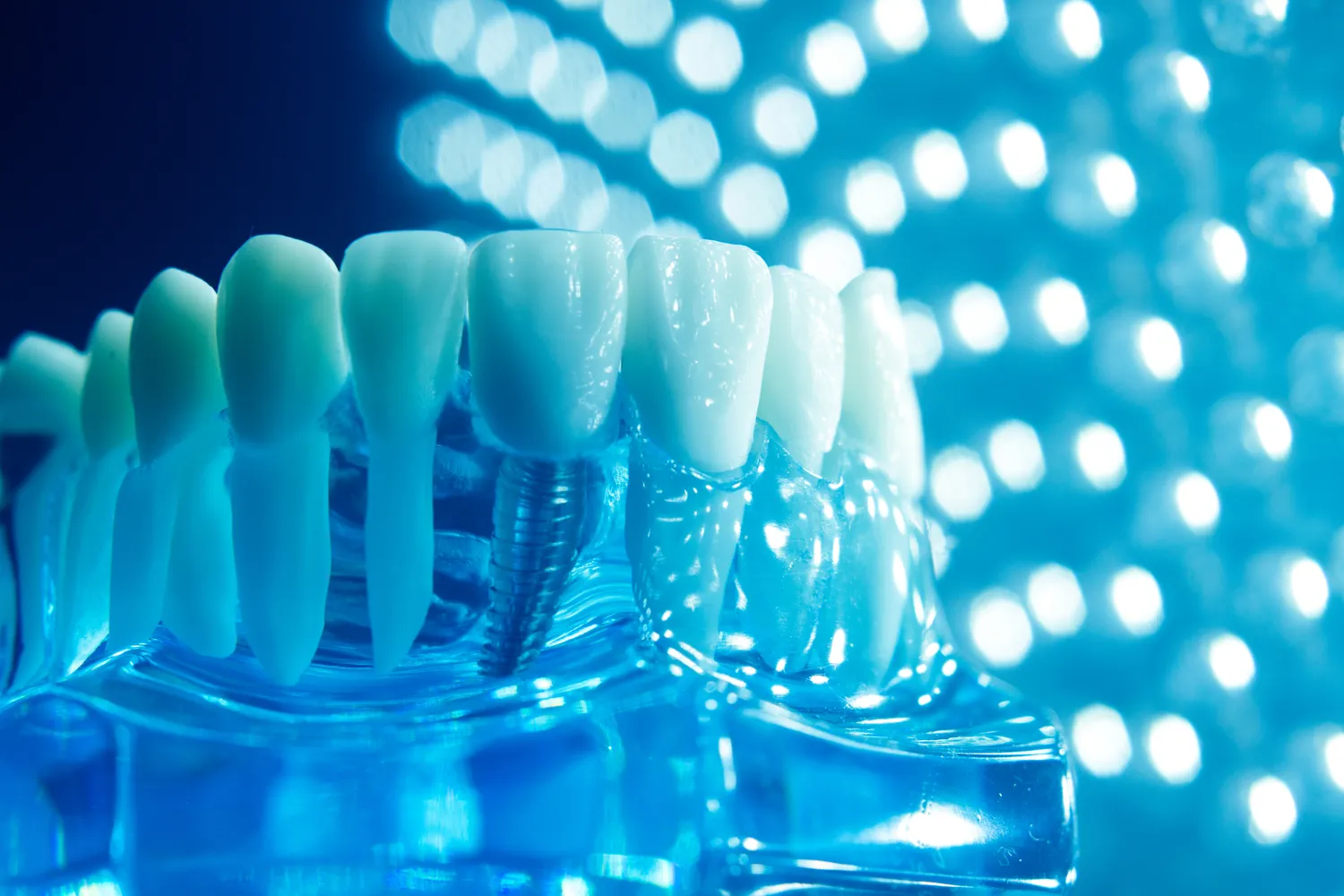 Implanty gdzie najlepiej opinie?